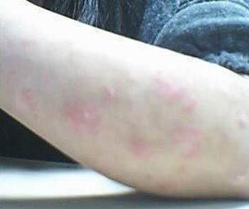 银屑病有哪些治疗方法 银屑病消退期的表现